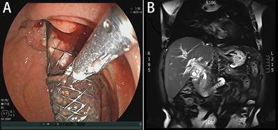 SpyGlass-Guided Photodynamic Therapy for Unresectable Cholangiocarcinoma: A Case Report and Review of the Literature